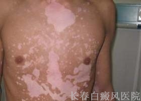 白癜风治疗什么方法好