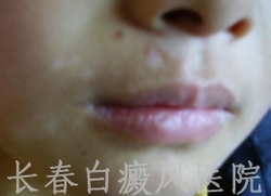 嘴角长白癜风怎么治