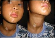 白癜风怎么彻底治疗
