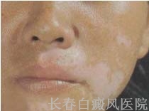 白癜风怎么治疗有效