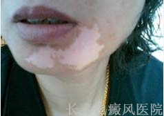 面部为什么会患白癜风