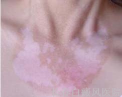 白癜风的治疗方法有哪些