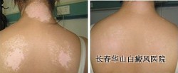得了白癜风能治愈吗