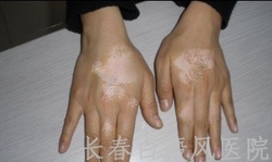 白癜风怎么治疗效果好