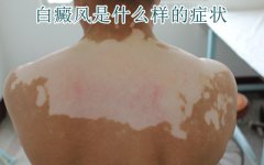 白癜风早期的症状表现