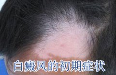白癜风有哪些早期症状表现