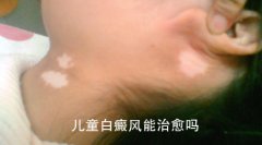 儿童白癜风能治好吗