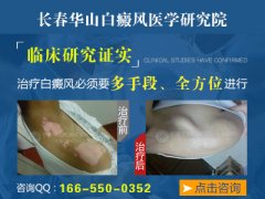 长春治疗白癜风的医院
