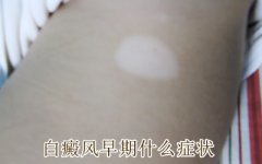 白癜风早期的症状有哪些