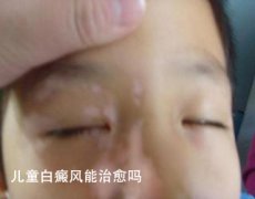如何治疗小孩的白癜风病