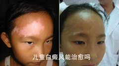儿童白癜风有哪些危害