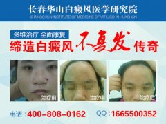 长春博润白癜风医院好吗