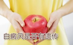 得了白癜风会传染吗