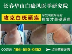 长春哪家医院治疗白癜风患者最好