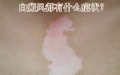 白癜风症状有哪些表现