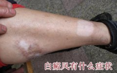 白癜风常见的症状有哪些