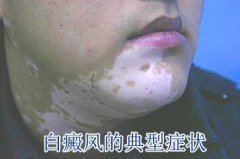 如何正确的诊断白癜风
