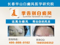 治疗白癜风有哪些注意事项