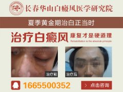 得了白癜风怎么样治疗好