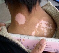 白癜风都有哪些方面的危害