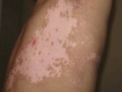 白癜风治愈后的注意事项