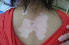 白癜风该怎样治愈
