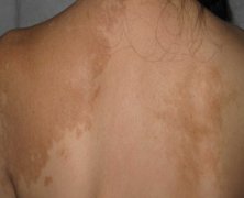 白癜风扩散有哪些症状