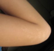 为什么会得白癜风呢