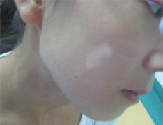 怎样的区别白斑病和白癜风