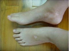 白癜风患者忌食那些食物