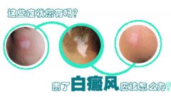 白癜风的初期症状