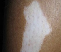 白癜风治疗时有哪些注意要点