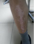 白癜风运动注意事项