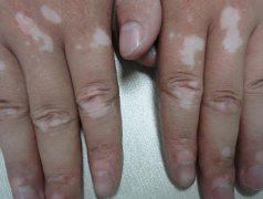光合作用对白癜风患者有哪些好处